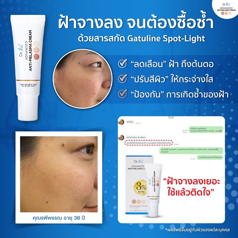 Melasma Cream รีวิว