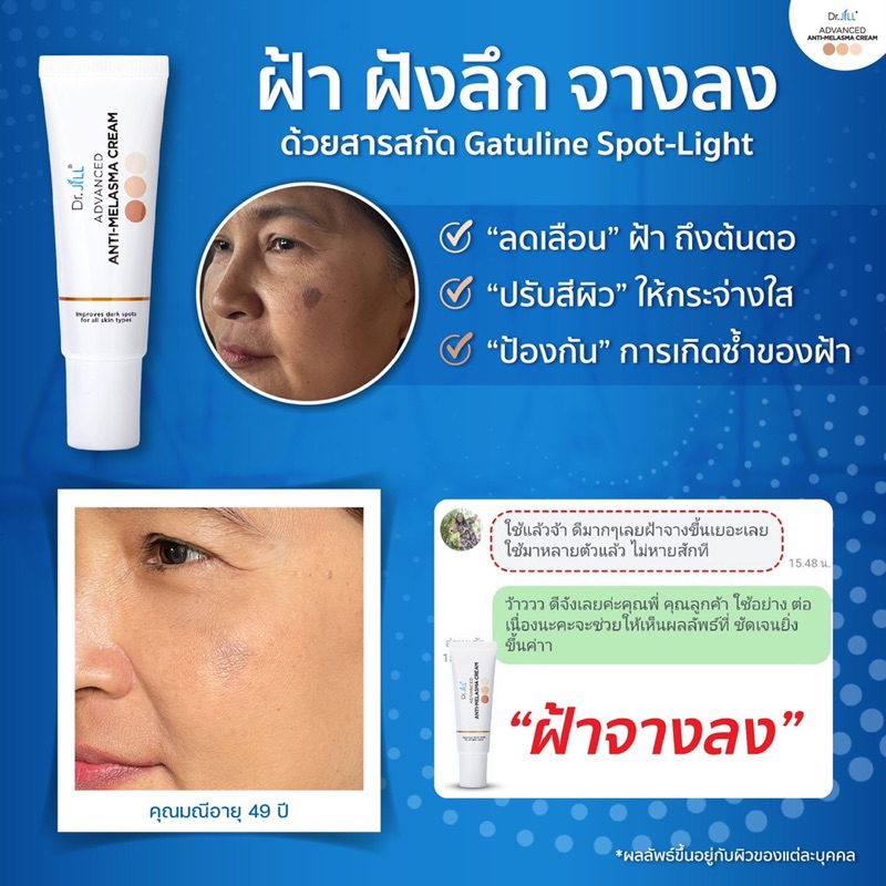 Melasma Cream รีวิว